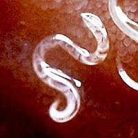 Ankylostomiasis